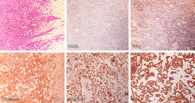 Pericardial mesotholioma immunohistochemistry